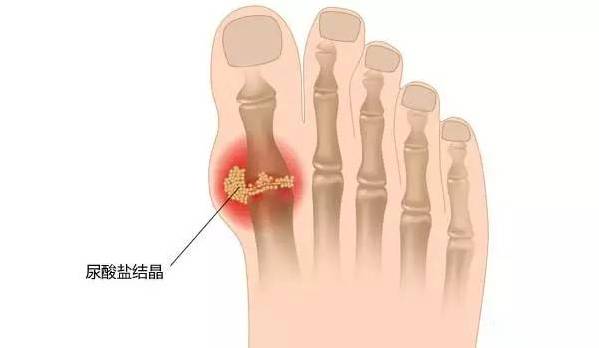 導致痛風發(fā)作的原因有哪些