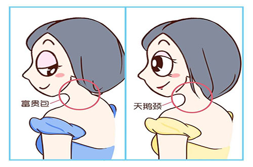 哪些習(xí)慣容易導(dǎo)致富貴包