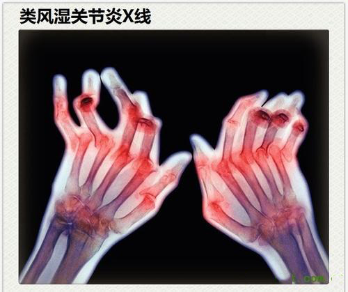 類風(fēng)濕性關(guān)節(jié)炎真的是“不死的癌癥”？