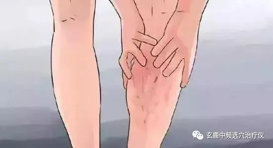 治療靜脈曲張，中醫(yī)有良方，一根針讓你告別“蚯蚓”腿